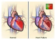 De que forma o coração e o corpo compensam a insuficiência cardíaca