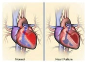 Comment le coeur et le corps s’adaptent en cas d’insuffisance cardiaque