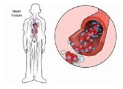 Comment l’insuffisance cardiaque provoque une rétention de liquides