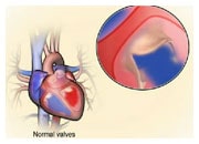 Comment des valves cardiaques anormales peuvent provoquer une insuffisance cardiaque