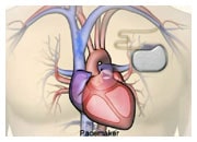 Hoe werken medische apparaten pacemaker, ICD bij hartfalen