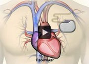 How medical devices work in heart failure